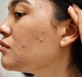 Unlocking the Secrets of Adult Acne: Causes, Mistakes, and Solutions