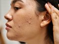 Unlocking the Secrets of Adult Acne: Causes, Mistakes, and Solutions