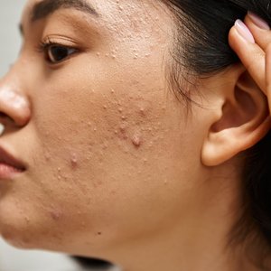 Unlocking the Secrets of Adult Acne: Causes, Mistakes, and Solutions