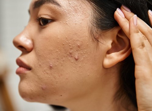 Unlocking the Secrets of Adult Acne: Causes, Mistakes, and Solutions