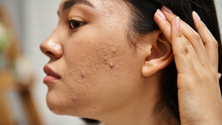 Unlocking the Secrets of Adult Acne: Causes, Mistakes, and Solutions